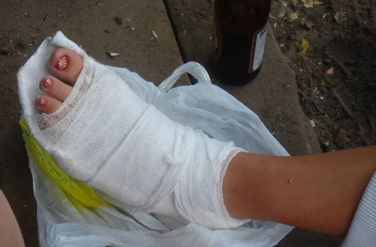 Место перелома на ноге